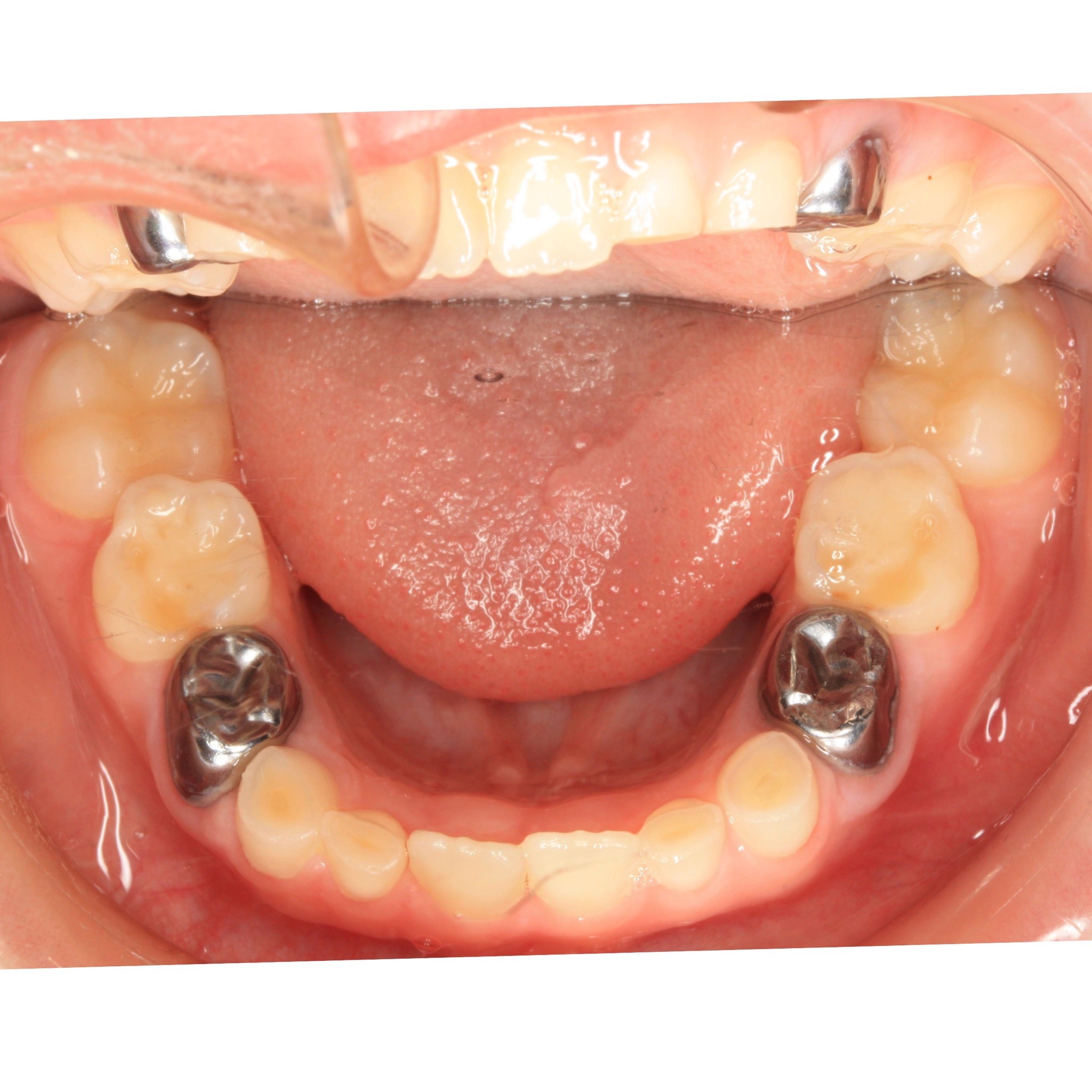 early-mixed-dentition-concerns-spear-talk