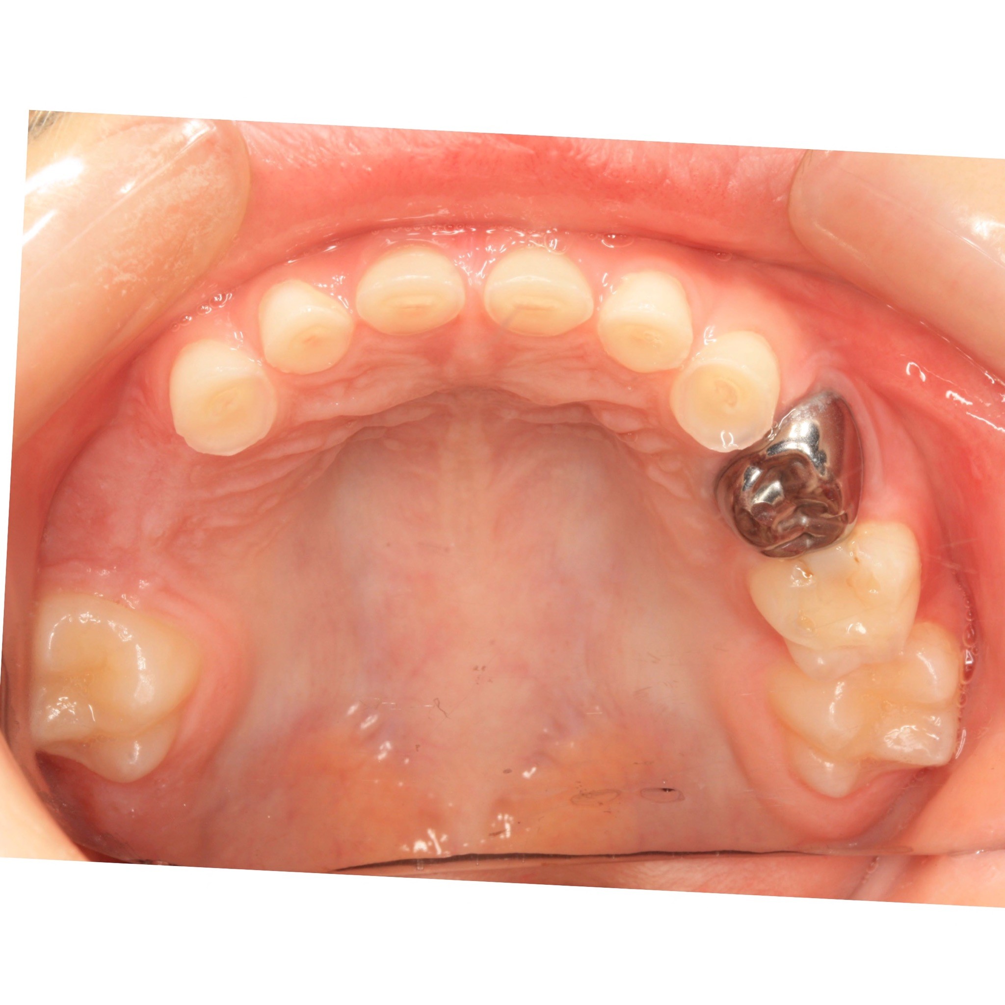 early-mixed-dentition-concerns-spear-talk