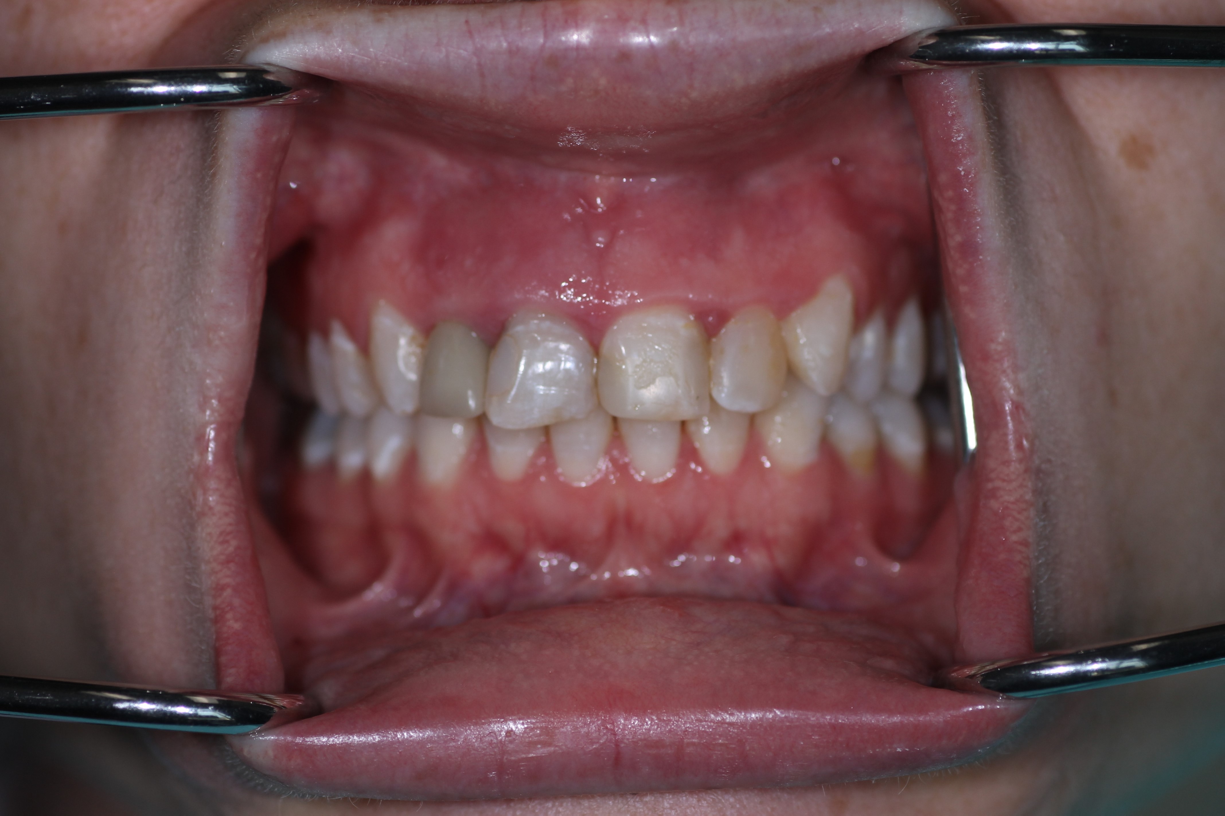 Key Ridge Ortyho Ridge Preservation/Augmentation and Ortho Treatment - Spear Talk