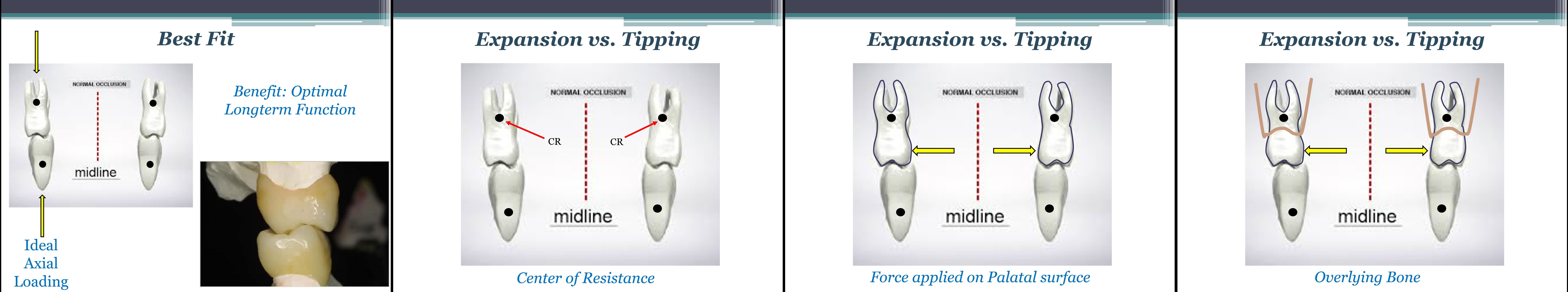 Invisaling Palatal Expander FDA Approval Spear Talk