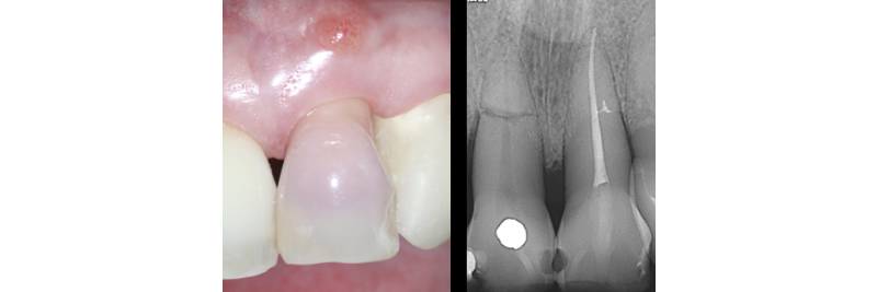 side by side of a tooth and the xray