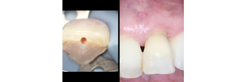 side by side of the underside of a tooth with a hole and a photo of the front