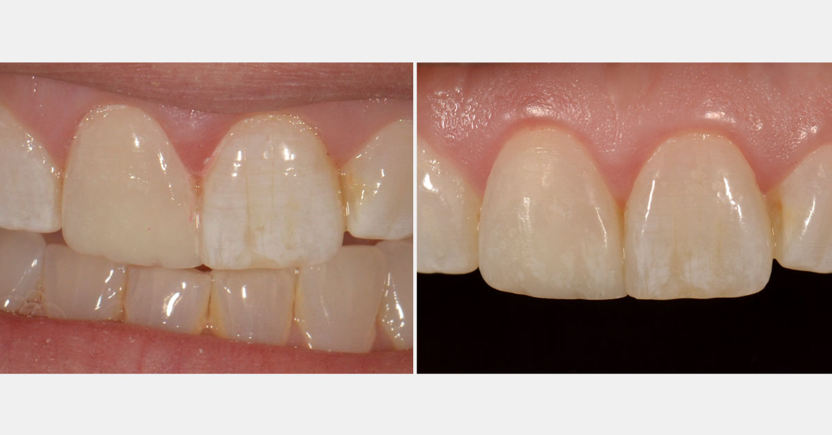 Before-and-after anterior composite restorations.