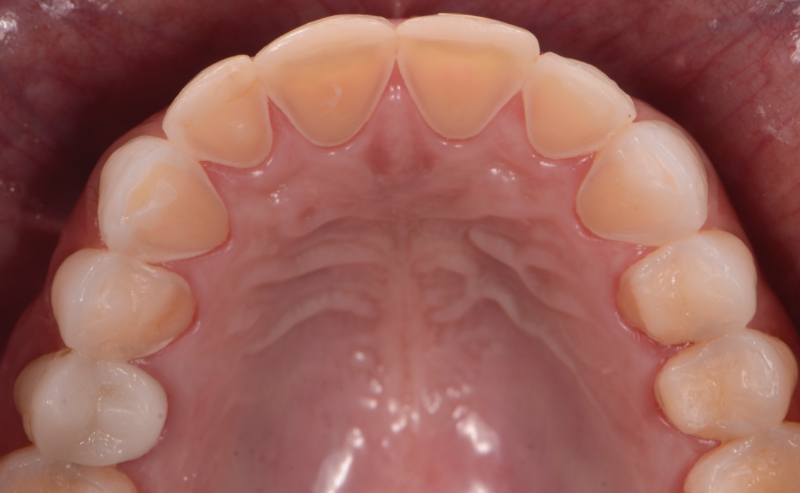 Intrinsic erosion lesions that are commonly found on the palatal surfaces of the maxillary teeth, followed by the occlusal and then the buccal surfaces.