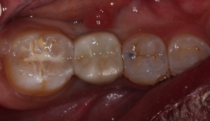 Example of access covered and delivery of screwmentable implant crown.