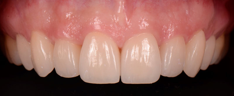 Ceramic veneers after cementation.