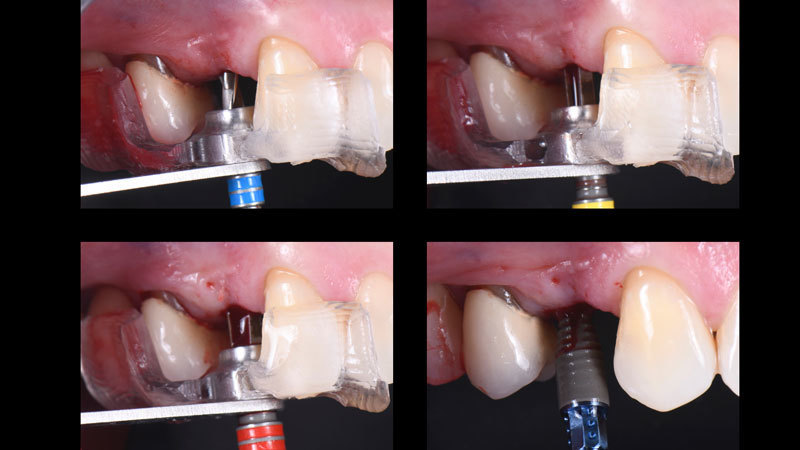 Drilling sequence of the Straumann Dental Implant System through the CEREC guide using the Sirona drilling keys.