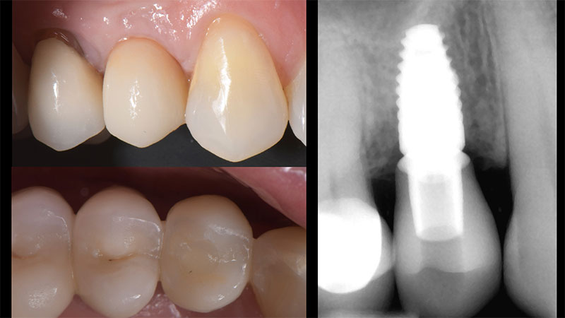 Front and occlusal view of the final restoration intraorally with last periapical radiograph.