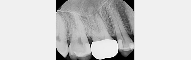 Radiograph showing UR6 crown recently cemented in a case where the patient became symptomatic.