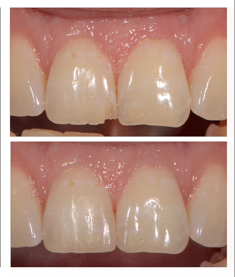 Example of bonding composites in the esthetic zone.