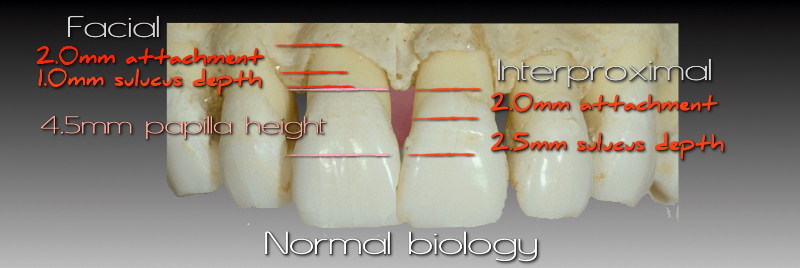 Facial and interproximal heights, normal biology.