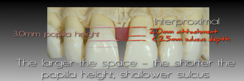 The larger the space, the shorter the papilla height, shallower sulcus.