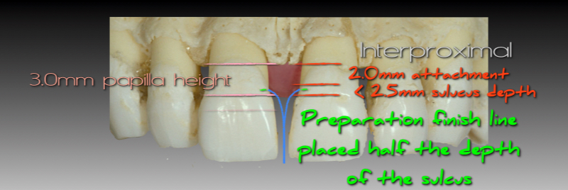 Preparation finish line placed half the depth of the sulcus.
