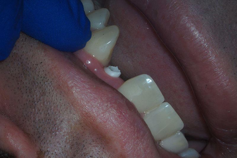 Broken abutment in mouth.