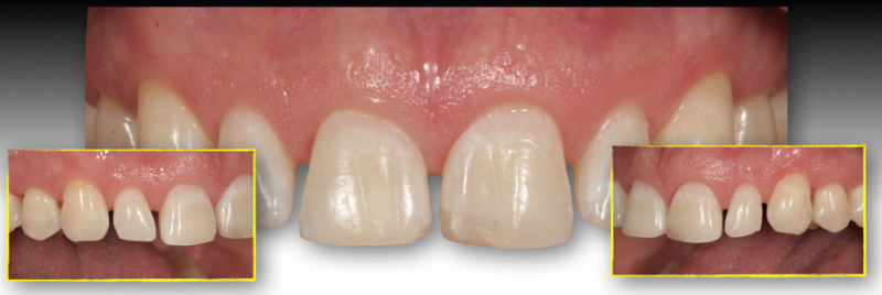 Teeth with the black triangle.