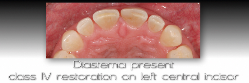 Diastema present, class IV restoration on left central incisor.