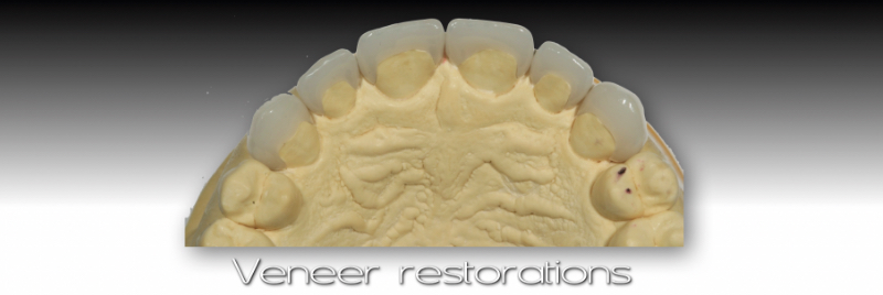 Contiguous transition from tooth to veneer.
