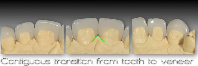 Veneer restorations.