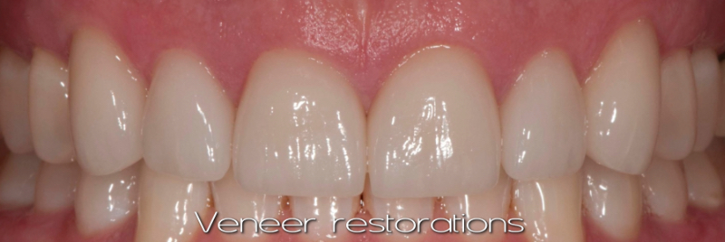Diastema present, class IV restoration on left central incisor.