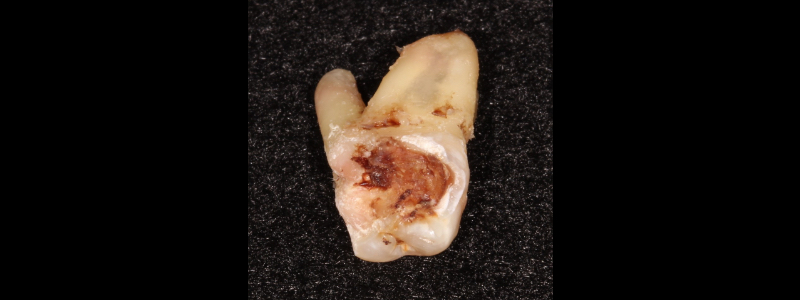 Before SDF – a freshly extracted tooth with dental caries.