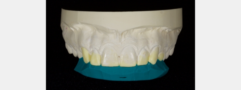 A PVS palatal stent diagnostic wax-up.