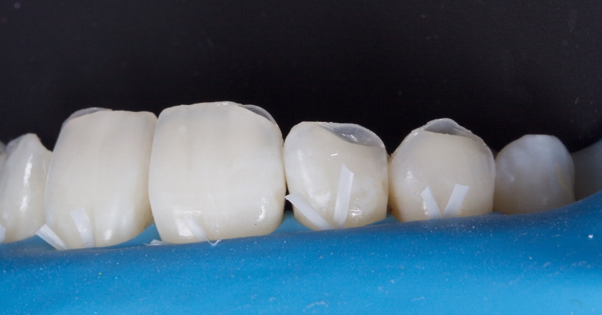 Figure 3: The missing tooth structure was replaced with direct composite resin in layers using the Natural Layering Approach, Dietschi.