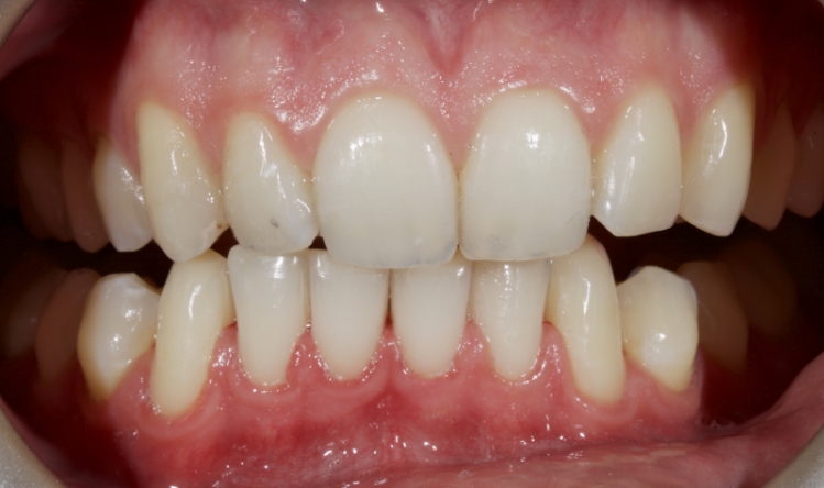 Figure 6: The new occlusal scheme from canine guidance.