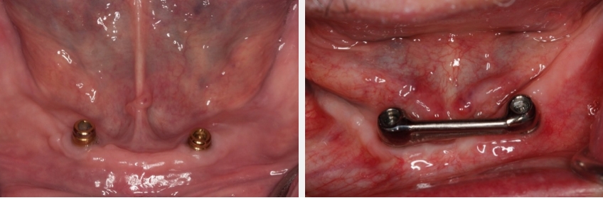 Intraoral view showing a tissue bar fabricated in one week or less, shown both with and without the bar connection.