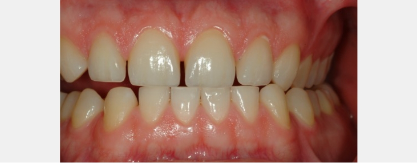 A) Representation of tooth position within the jaw of the extant Great