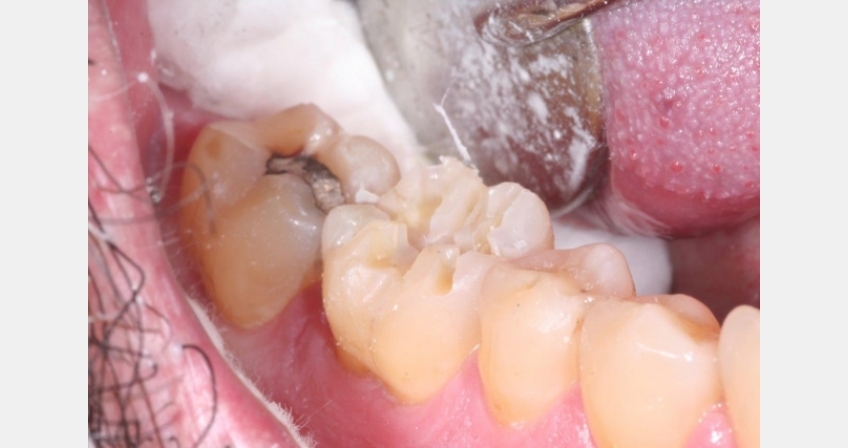 Dental crown preparation