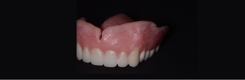 front view trimmed denture liner