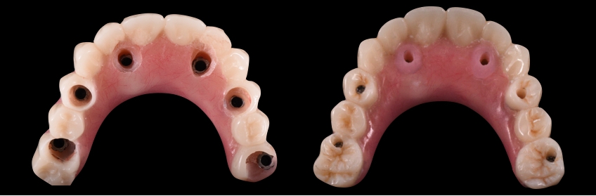 Occlusal views of the prosthesis after the pick-up technique and after the composite freehand technique to reconstruct the loss of anatomy.