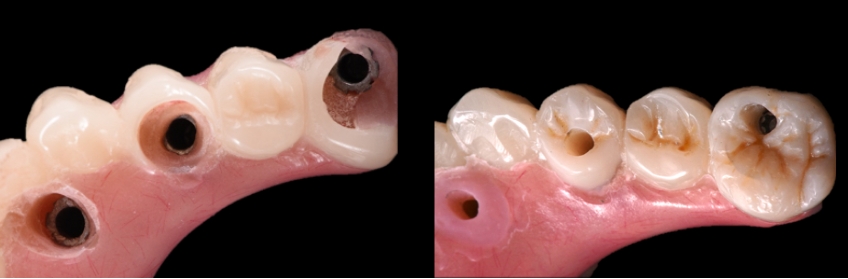 A before and after view of the composite freehand technique reconstructing the loss of anatomy.