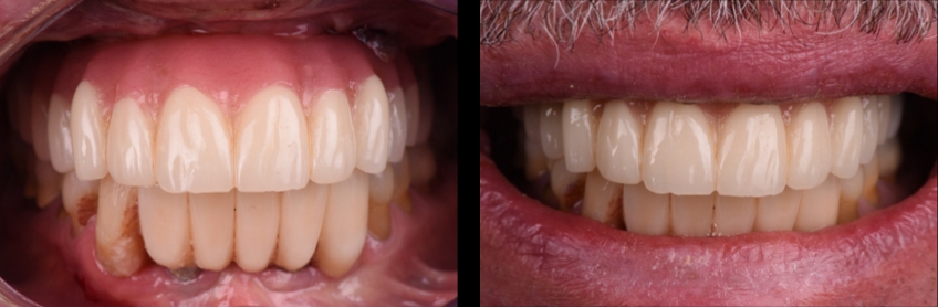 Immediately loaded provisional prosthesis after surgery and insertion.