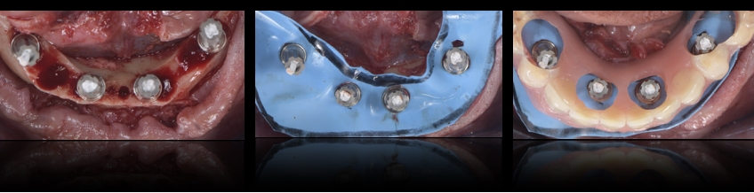 Conversion prosthesis procedure with wide-open areas for pick-up.