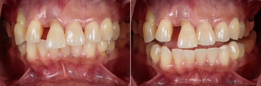 occlusion at MIP (left) and with the teeth slightly apart (right)