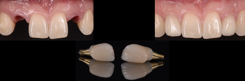 Frontal view before and after zirconia layered screw-retained implant-supported prosthesis