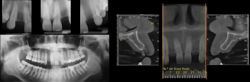 Periapical, panoramic, and sagittal views from the CBCT.