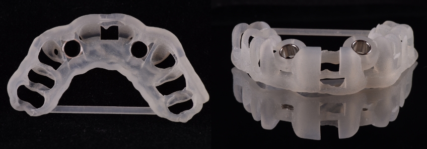 3D printed surgical guide