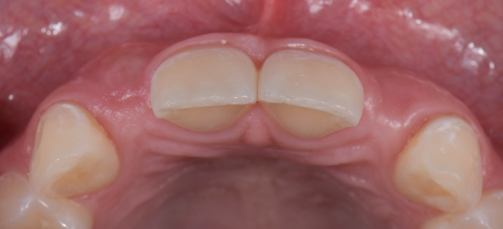 Post-orthodontic with bilateral congenitally missing lateral incisors.