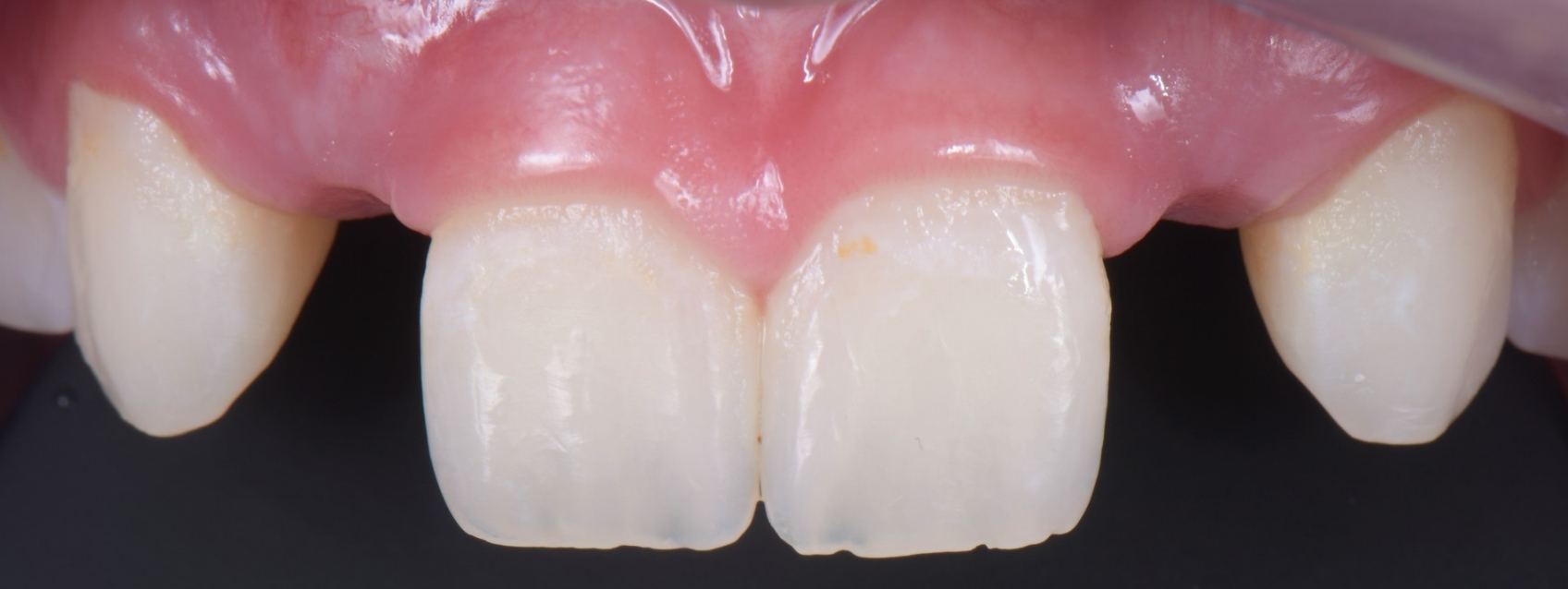 The gingival architecture is groomed to create a more pleasing outline.