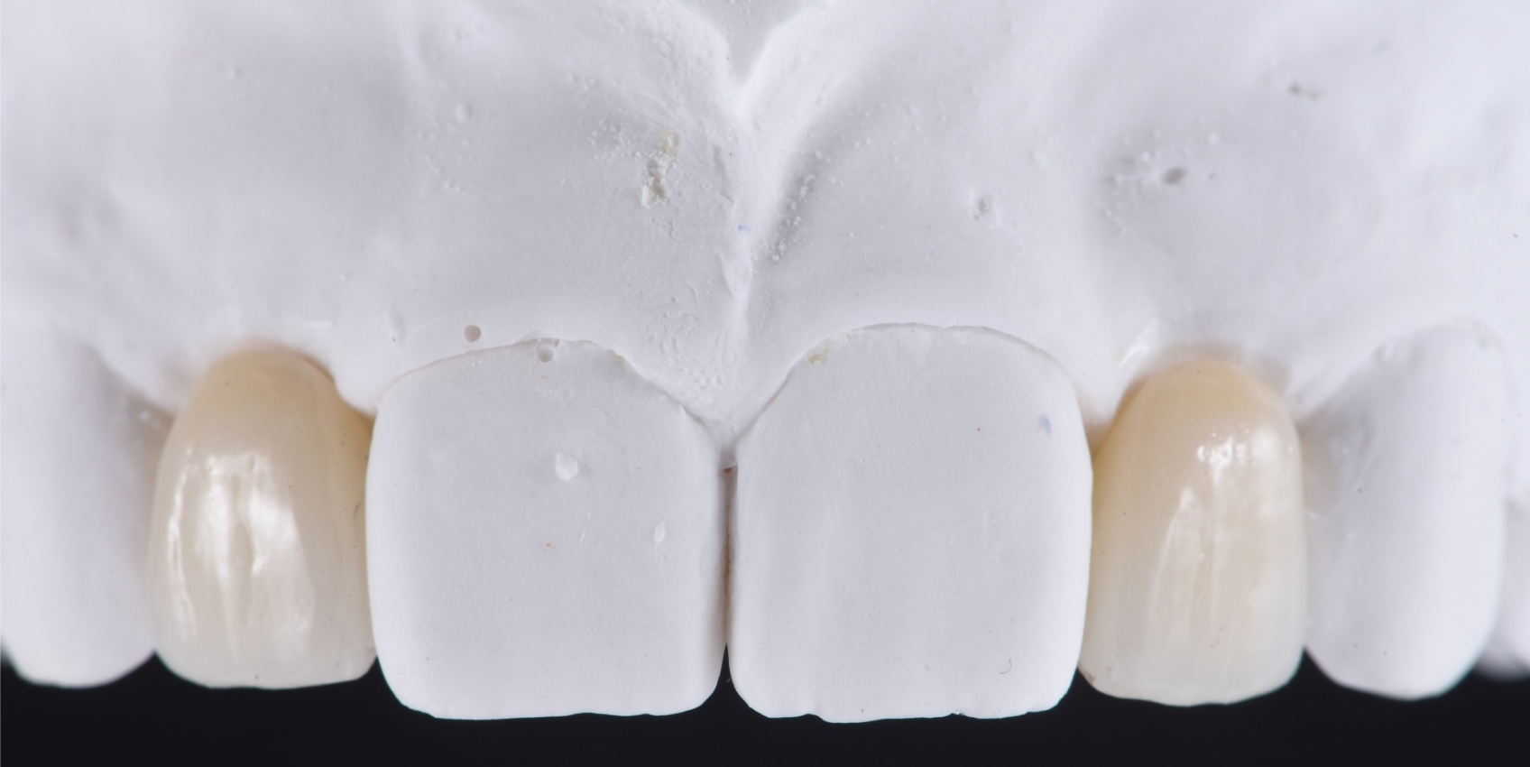 A zirconia-layered single retainer RBFPD is fabricated.