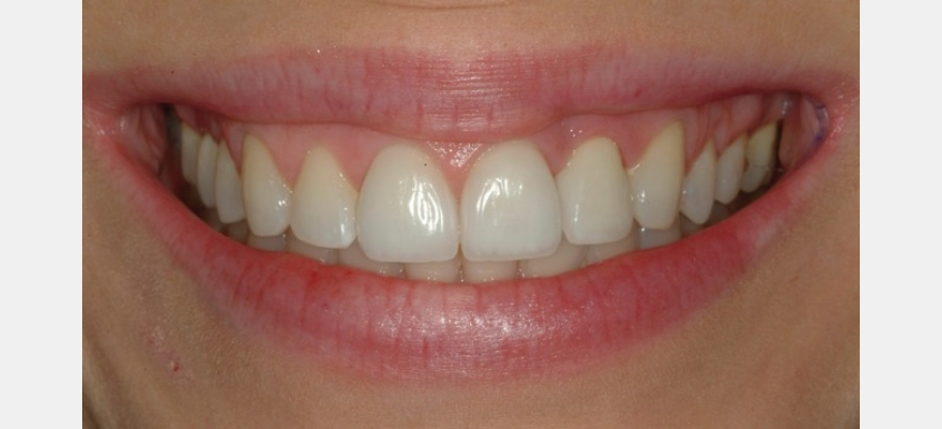 Using Golden Percentage in Dentistry for Ideal Tooth Proportions ...