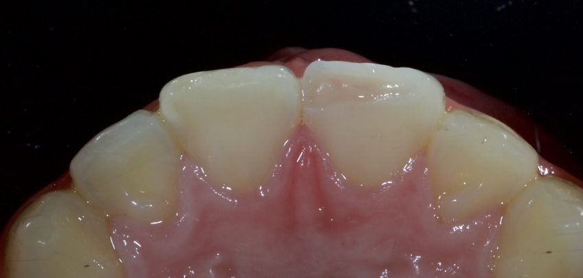 Close up of upper left central incisor (2.1) with fracture