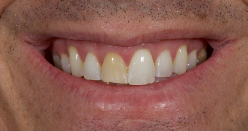 patient smile with discoloration in upper right central incisor