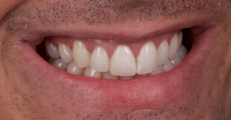 patient smile after restoration