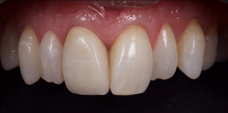 close up of teeth with new direct composite resin veneer