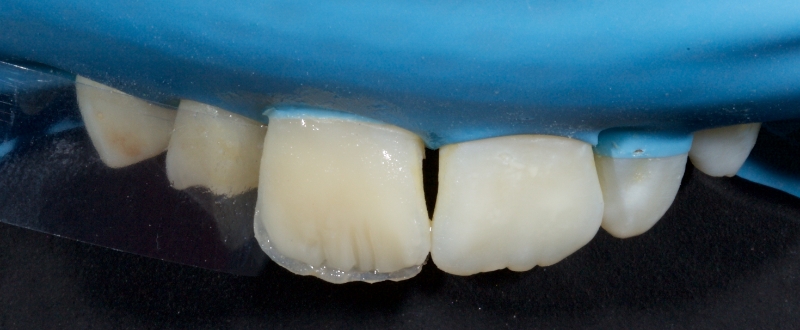 close up of teeth with rubber dam applied