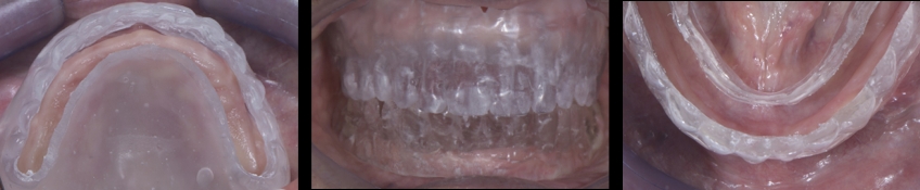 Frontal and occlusal views of the surgical guides