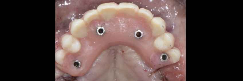 Occlusal view of immediately loaded prosthesis after insertion